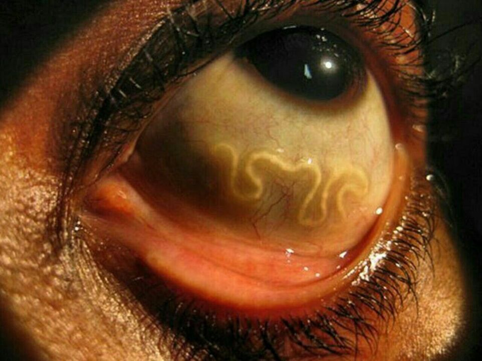 pasożyty w ludzkim oku